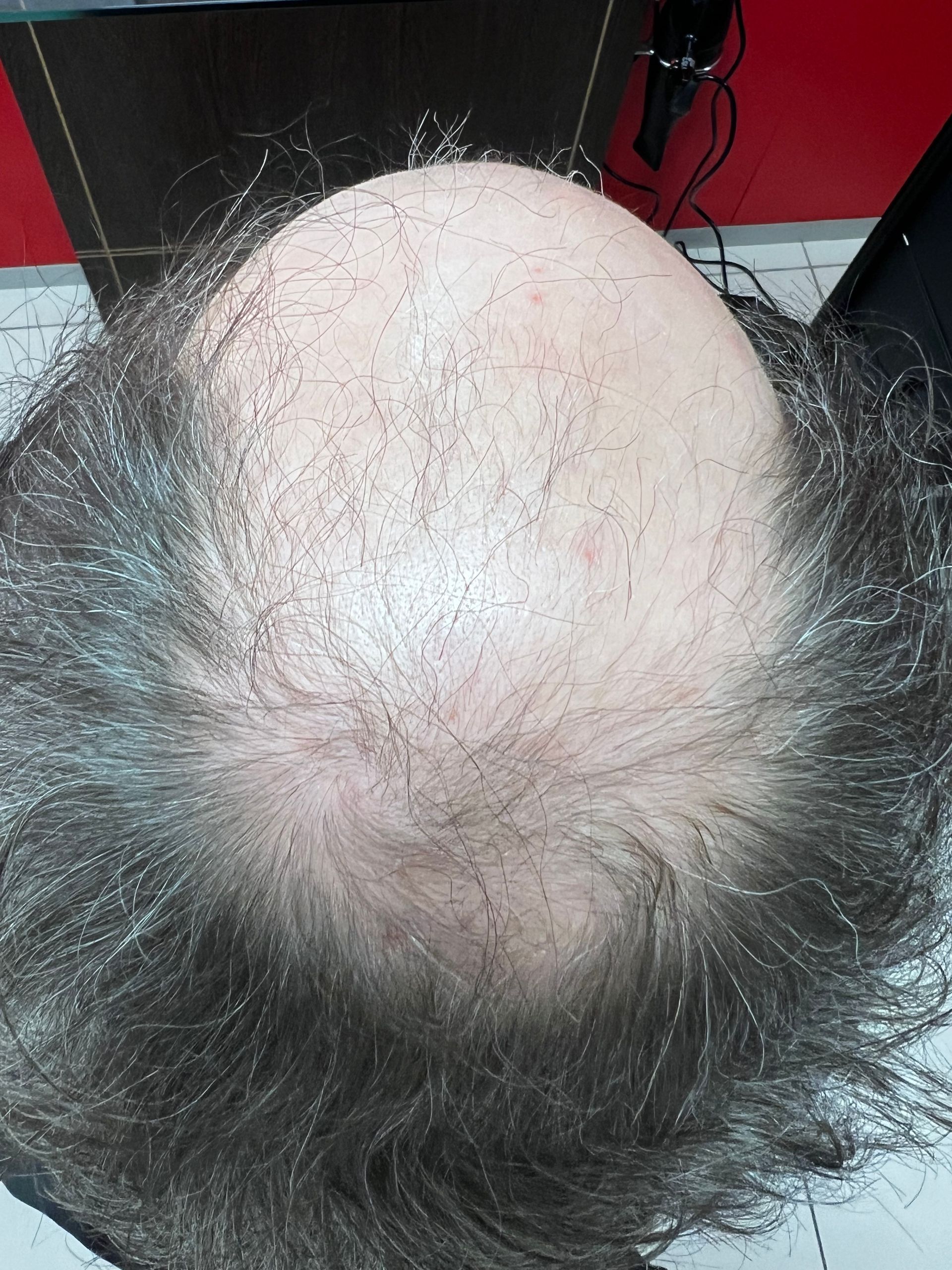 Un homme avec une calvitie