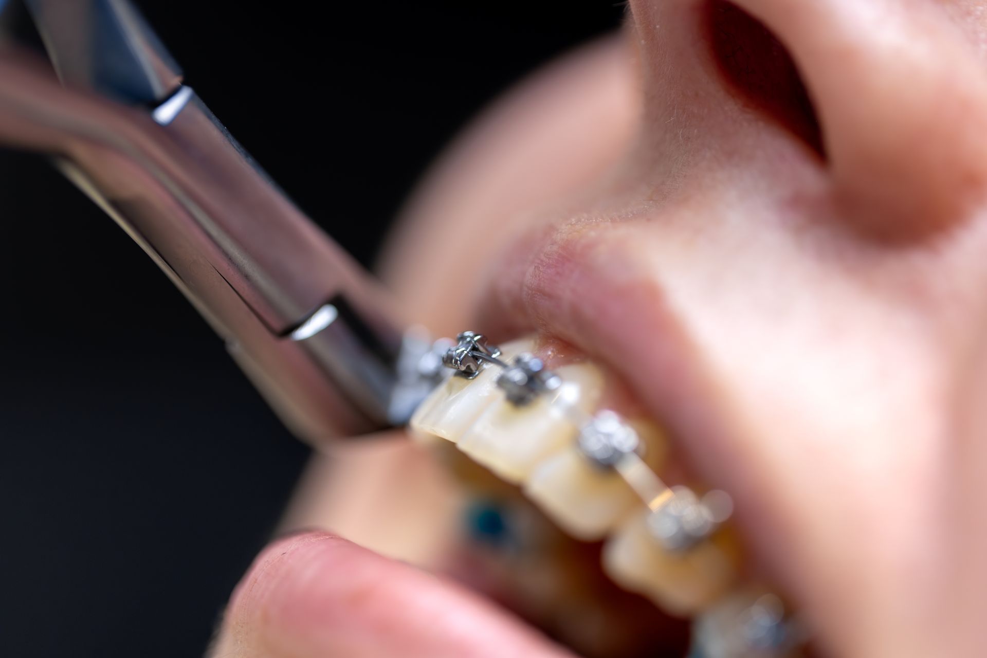Primer plano de un instrumento dental para ajustar los aparatos de ortodoncia en los dientes de un paciente.