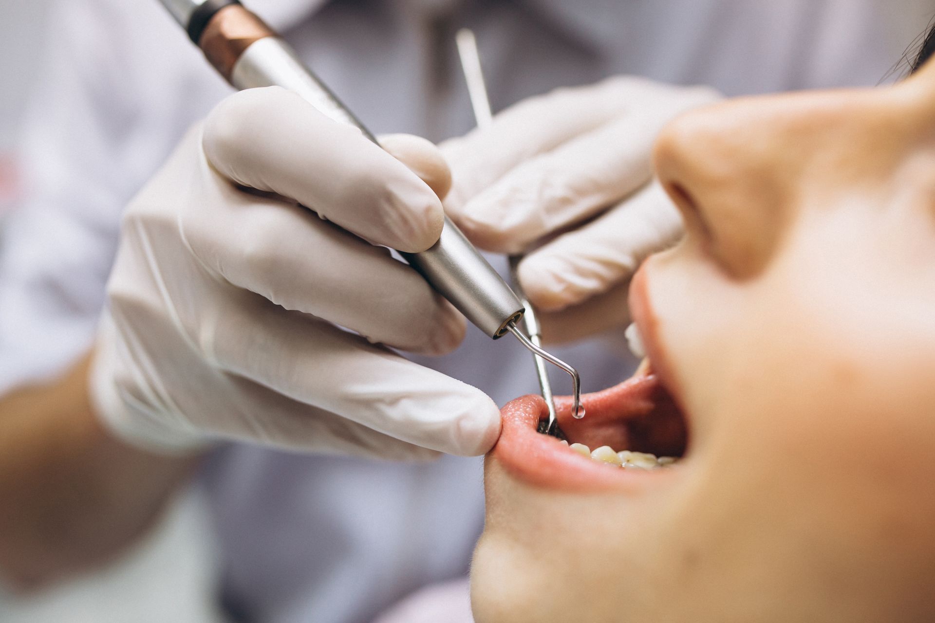 Dentista usando un taladro en la boca abierta de un paciente mientras usa guantes blancos.