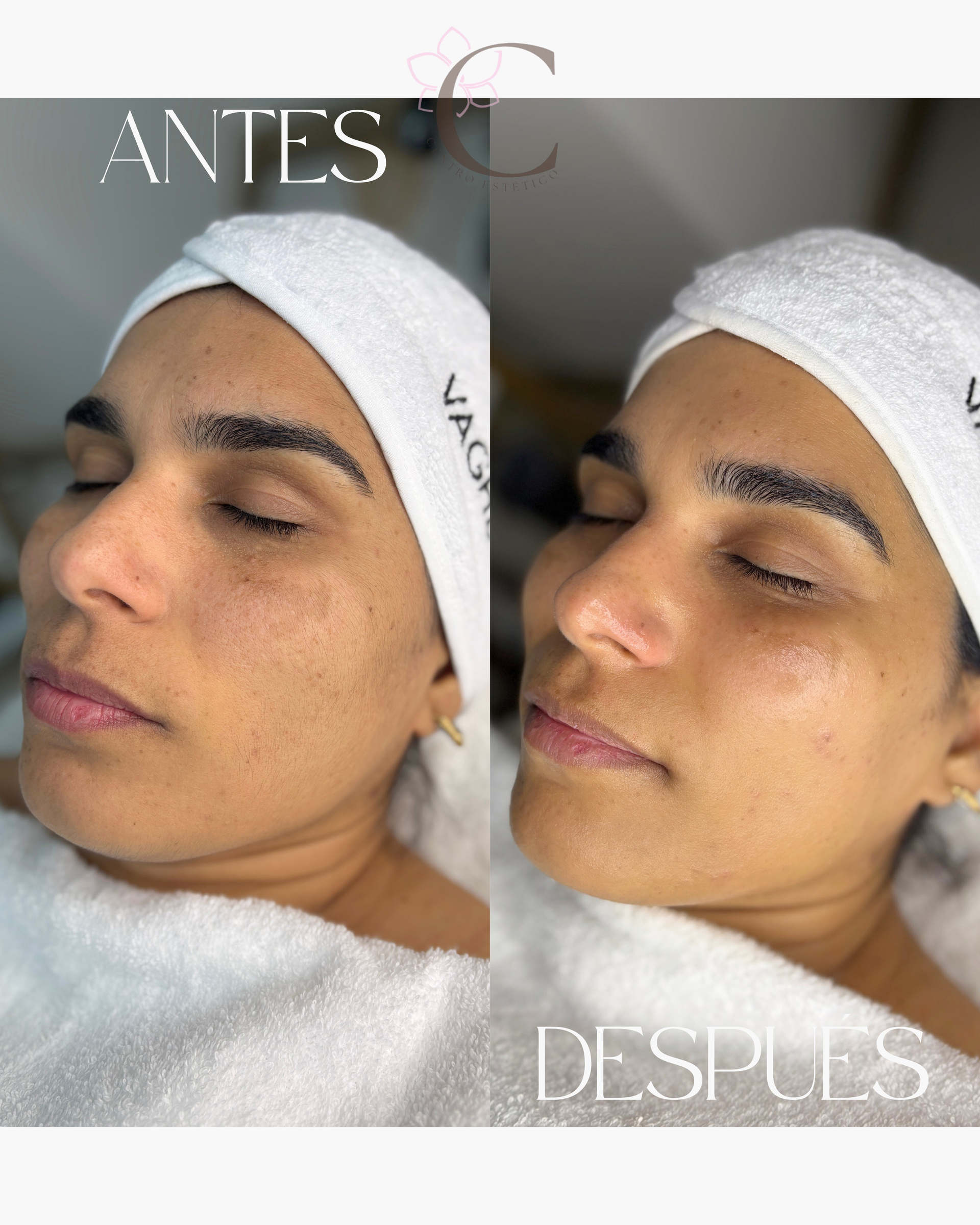 Comparación del antes y el después del rostro de una mujer. Las manchas oscuras se redujeron después del tratamiento.