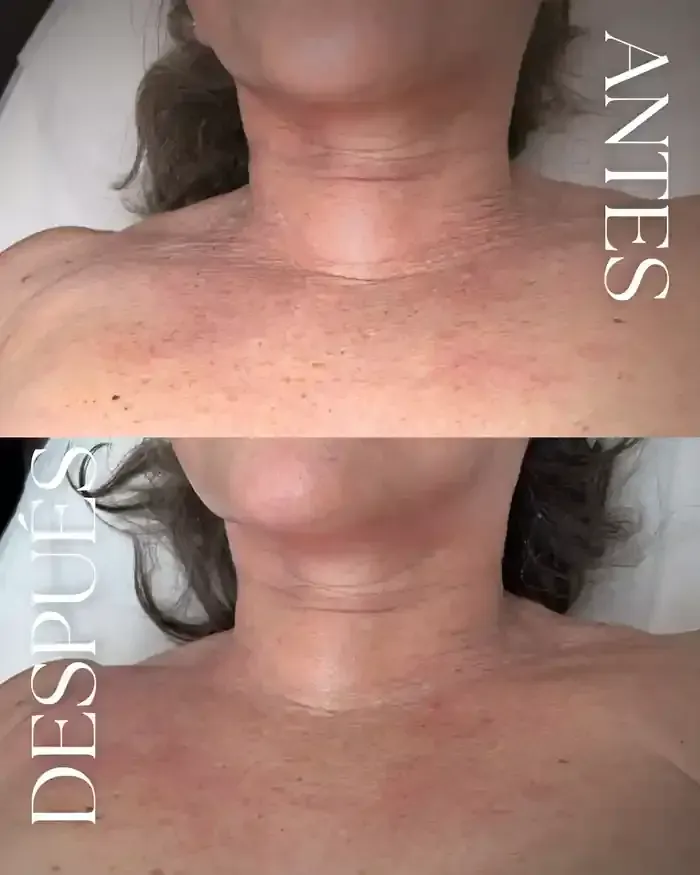 Una fotografía de antes y después del cuello y el pecho de una mujer.