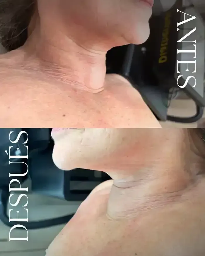 Una foto de antes y después del cuello y los hombros de una mujer.