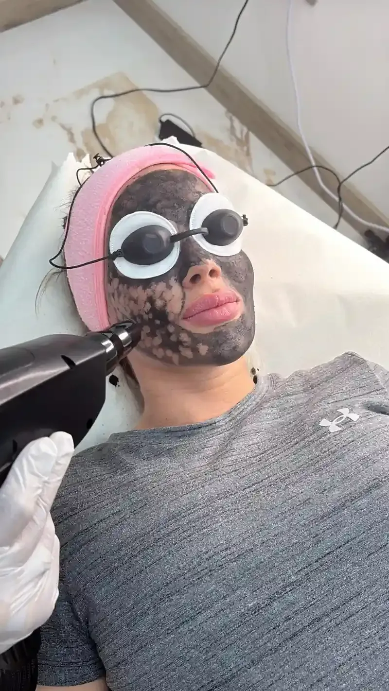 Una mujer está recibiendo un tratamiento con láser en su cara.