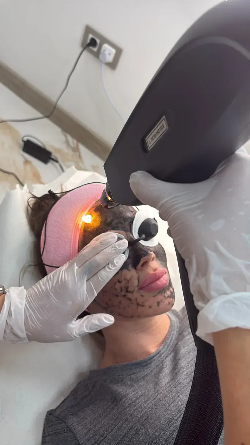 Una mujer está recibiendo un tratamiento con láser en su cara.