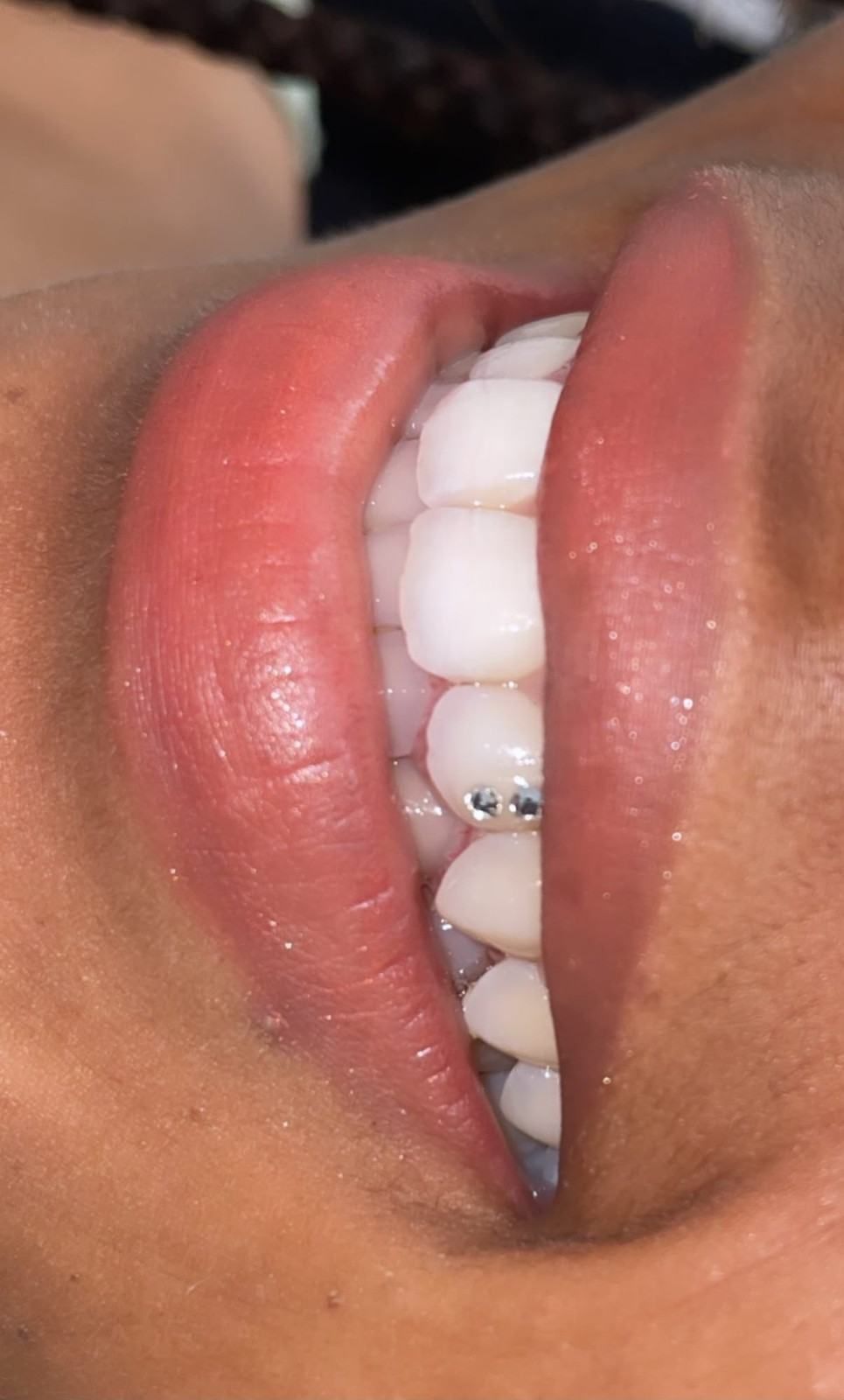 Primer plano de los labios entreabiertos que muestran los dientes blancos con un pequeño soporte dental.