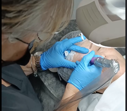 Una persona se somete a un microblading de cejas. Una mano enguantada sostiene una herramienta, mientras que otra la guía. Una luz brillante ilumina al paciente.