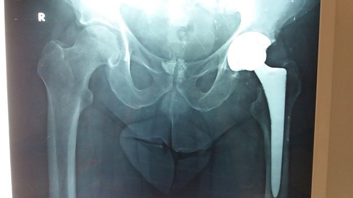 Ολική αρθροπλαστική ισχίου