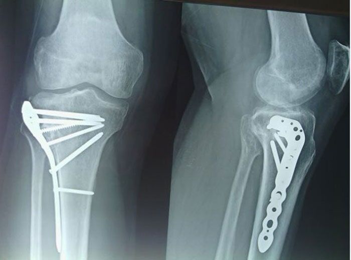 Εσωτερική οστεοσύνθεσηκατάγματος κνήμης