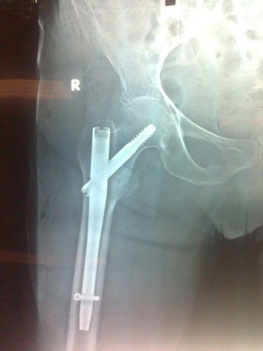 Ήλωση διατροχαντηρίου κατάγματος μηριαίων