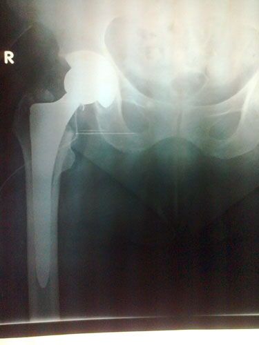 Οστεοσύνθεση κατάγματος αγκώνος