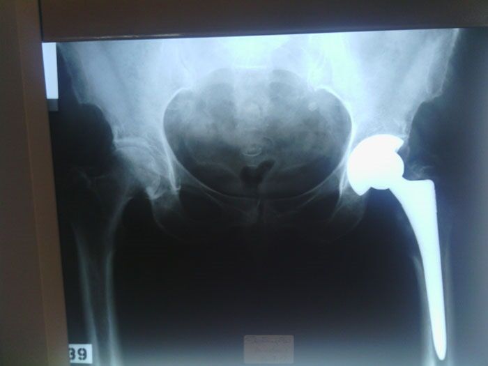 Ολική αρθροπλαστική ισχίου