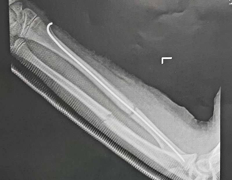 Εύκαμπτος ενδομυελικός ήλος σε κάταγμα διάφυσης κερκίδας σε παιδί (κορίτσι)