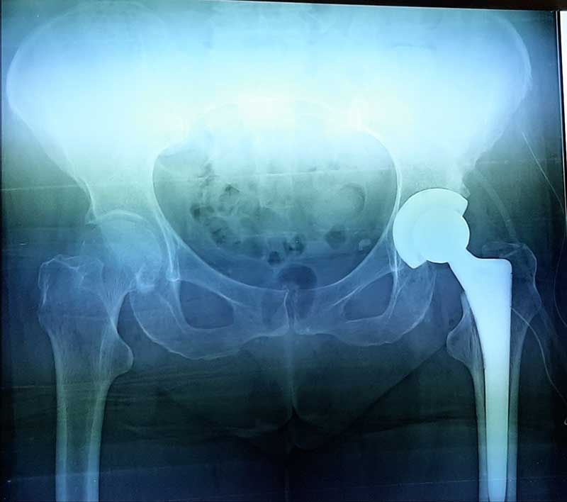 Ολική αρθροπλαστική ισχίου