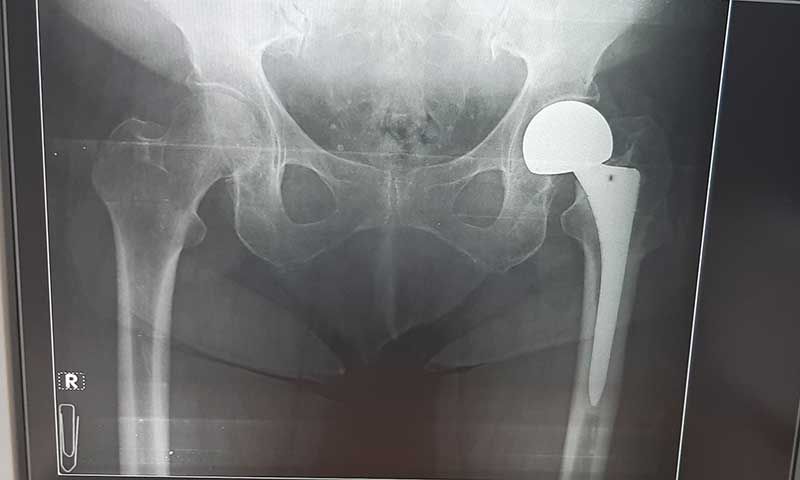 Ημιολική αρθροπλαστική ισχίου