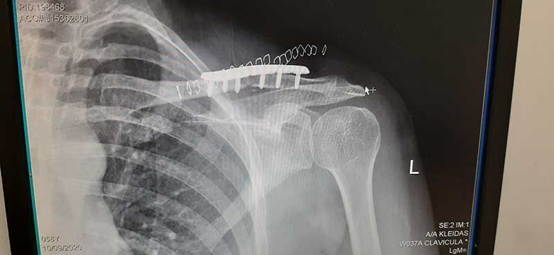 Εσωτερική οστεοσύνθεση κατάγματος κλείδας