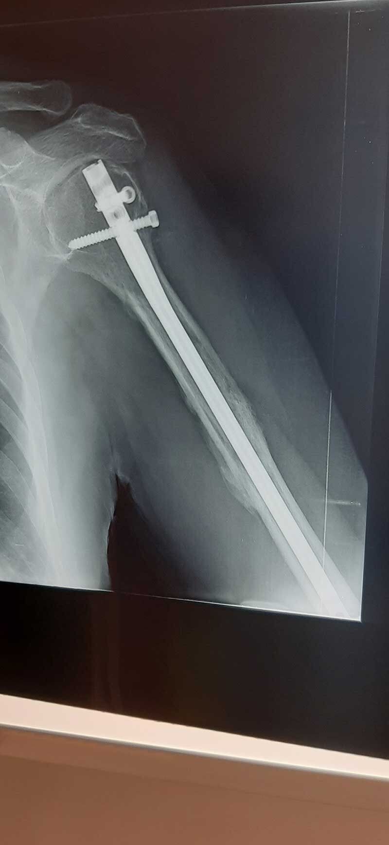 Ενδομυελική ήλωση κατάγματος βραχιονίου