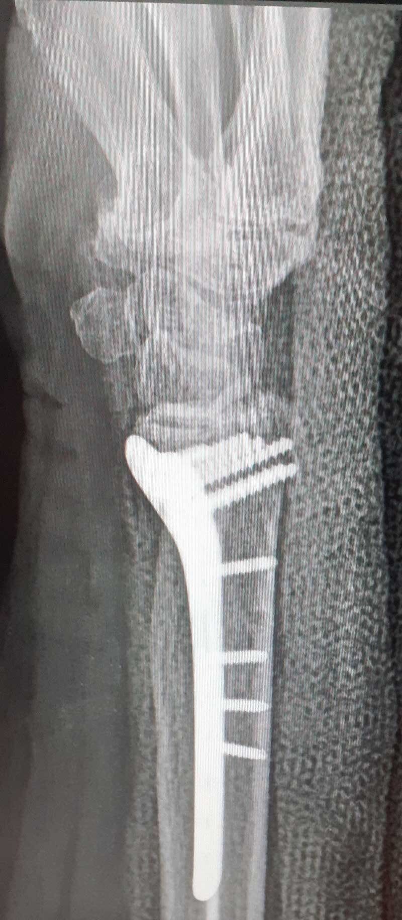 Εσωτερική οστεοσύνθεση κατάγματος κερκίδας