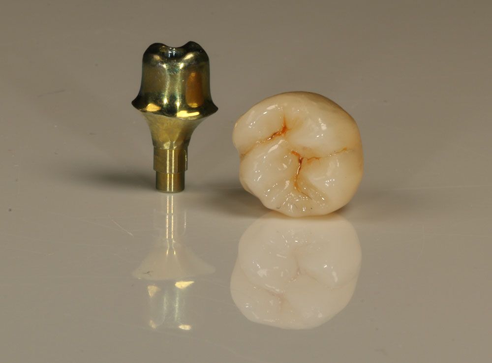 Individuelle Abutments