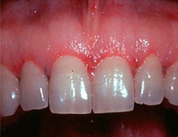 Un primer plano de los dientes de una persona con encías rojas.