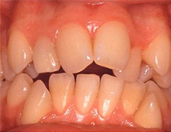 Un primer plano de los dientes de una persona a la que le falta un diente.