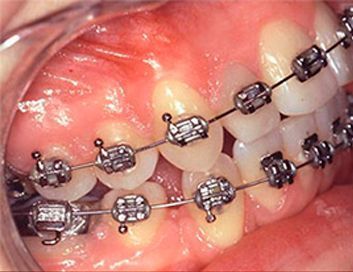 Un primer plano de los dientes de una persona con aparatos ortopédicos.