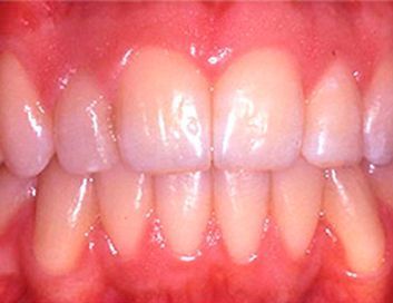 Un primer plano de los dientes y las encías de una persona.