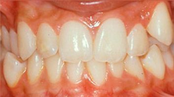 Un primer plano de los dientes y las encías de una persona.