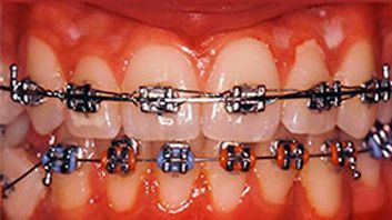 Un primer plano de los dientes de una persona con aparatos ortopédicos.