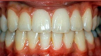 Un primer plano de los dientes de una persona con encías rojas.