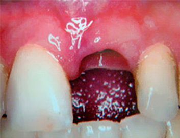 Un primer plano de un diente con un agujero en él.