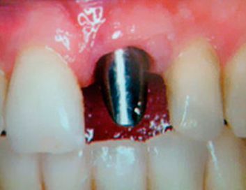 Un primer plano de los dientes de una persona con un diente de metal en el medio.