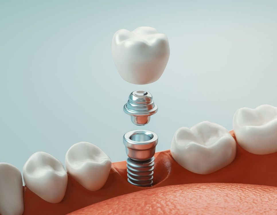 Image de synthèse d'un implant dentaire.