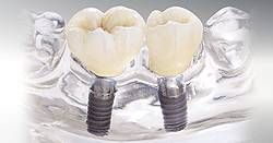 Bei dieser Implantatversorgung wurden zwei Seitenzähne im Unterkiefer ersetzt. Diese Lösung ist besonders sinnvoll, wenn wie hier die angrenzenden Pfeilerzähne stark gekippt stehen und deshalb eine konventionelle Brückenkonstruktion erschweren würden.