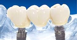 Bei dieser Implantatversorgung wurden zwei Seitenzähne im Unterkiefer ersetzt. Diese Lösung ist besonders sinnvoll, wenn wie hier die angrenzenden Pfeilerzähne stark gekippt stehen und deshalb eine konventionelle Brückenkonstruktion erschweren würden.