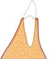 Zahn im Knochen mit gesundem Zahnfleisch