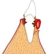 Fortschreitende Taschenbildung mit weitgehendem Knochenabbau und Zahnlockerung