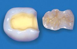 Keramik-Inlay mit individueller Farbgestaltung