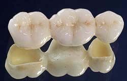 Vollkeramische Kronen und Brücken