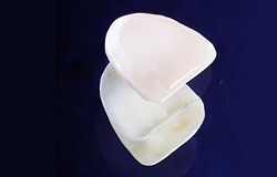 Frontzahn - Veneers aus Vollkeramik