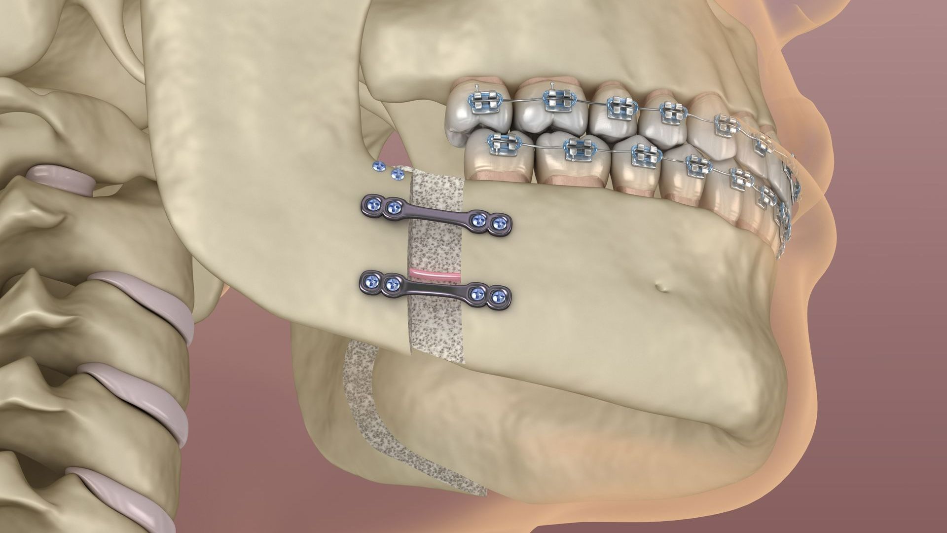 Photo d'un squelette avec des dents et une mâchoire soignées
