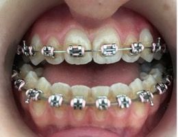 Photo avant béances