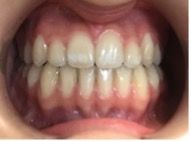 Photo après béances