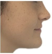 Photo après Classe III