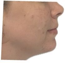 Photo après Classe II