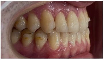 Photo après Classe III