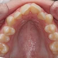 Photo des endognathies