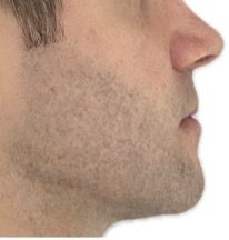 Photo après Classe III