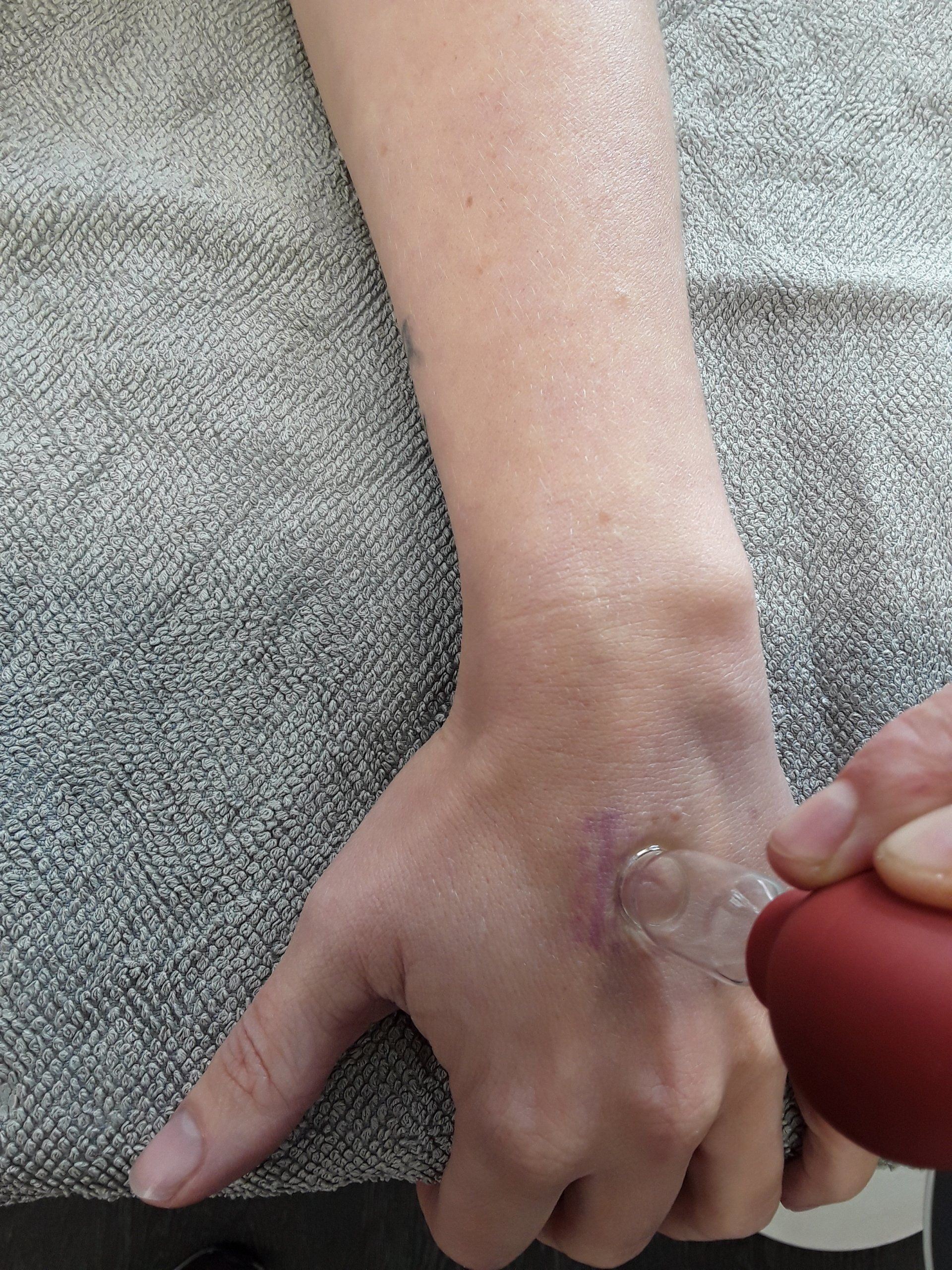 Arm und Hand einer Person werden mit einem Schröpfgerät behandelt. Die Haut ist blass und hat einen rötlichen Farbton.