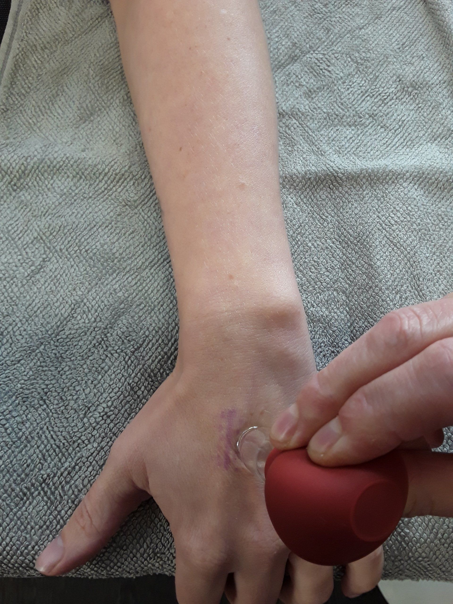 Handgelenk einer Person mit angelegtem Schröpftherapiegerät. Roter Saugnapf an der Hand. Hellbraune Haut mit eingedrückter Markierung.