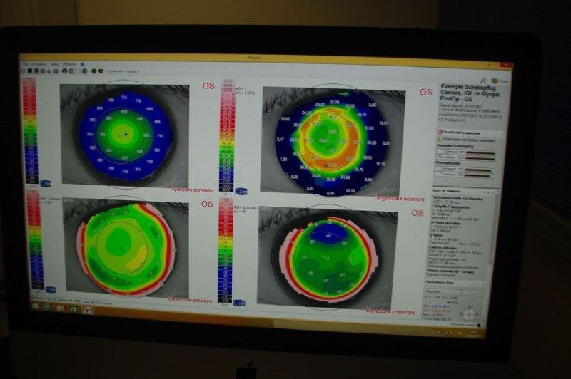 Un monitor di computer mostra quattro immagini diverse dell'occhio di una persona